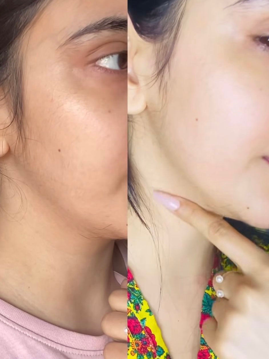Whitening Kit