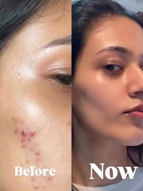 Acne Kit